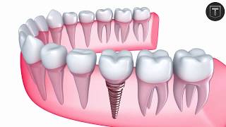 Titanium Dental Implant Surgery 3D Animation [upl. by Bohner]