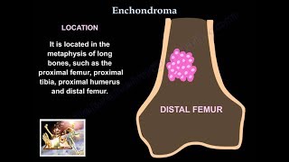 Orthopedic Oncology Course  Introduction to Musculoskeletal Tumors  Lecture 1 [upl. by Idaline522]