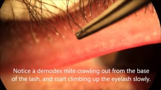 Demodex video [upl. by Carvey]