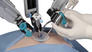 Dislocating Knee Cap Surgery  MPFL Reconstruction [upl. by Erodoeht]