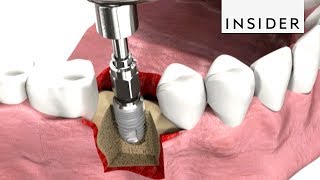 How Dentists Insert Dental Implants [upl. by Arat]