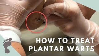 Plantar Wart Treatment  Auburn Medical Group [upl. by Blankenship]