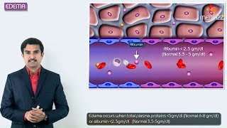 1Edema introduction  Hemodynamic pathology Fmge Neet PG and usmle [upl. by Laius656]