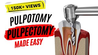 Pulpotomy and Pulpectomy  PEDIATRIC DENTISTRY [upl. by Theurich]