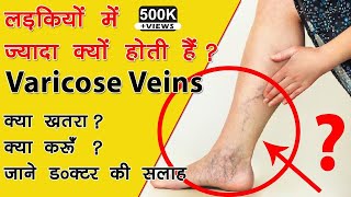 Varicose Veins Treatment In Hindi Causes Complications Treatment LASER Surgery blood Clot Leg [upl. by Anitnelav]