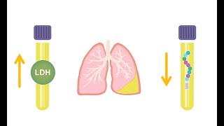 Differentiating transudative and exudative effusions transudate vs exudate [upl. by Depoliti]