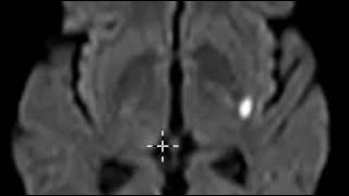 Acute lacunar infarction basal ganglia [upl. by Ichabod]