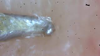 Demodex Facemite removal [upl. by Juliet]