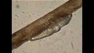 Demodex brevis moving on eye lash [upl. by Olegnaleahcim]