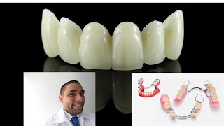 Prótesis Dental Removible o Fija Como son Cual es la diferencia [upl. by Rothstein]