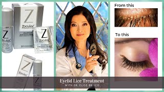 Demodex or Eyelid Lice 🐜 Treatment with Dr Brisco [upl. by Deacon]