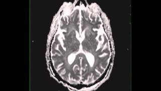 Cryptococcal meningitis [upl. by Ardy]