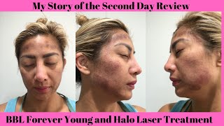 Day 2  Forever Young BBL and Halo Laser Treatment [upl. by Brenna]