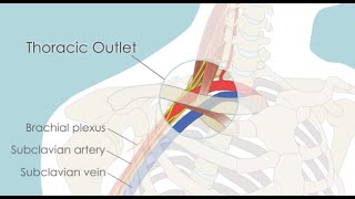 UltrasonographyGuided OMT of Thoracic Outlet Syndrome [upl. by Edveh987]