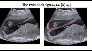 Twin peak sign or lambda sign  feature of dichorionic diamniotic twin pregnancy [upl. by Niret]