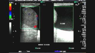 Ultrasound Tutorial InguinalFemoral Hernia Assessment  Radiology Nation [upl. by Race]