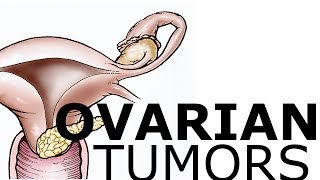 Ovarian Pathology amp Tumors [upl. by Desirae253]