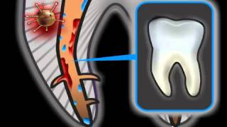 Root Canal Treatment Complications  Risks [upl. by Kuska]