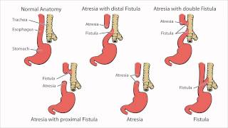 Esophageal Atresia  What is Esophageal Atresia [upl. by Chrysler664]