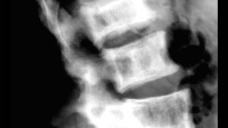 Pagets Disease of the Lumbar Spine on X ray [upl. by Cheng]