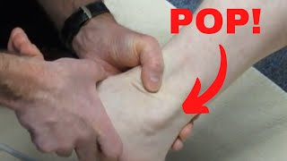 Peroneus longus subluxation How to treat it [upl. by Sekoorb]