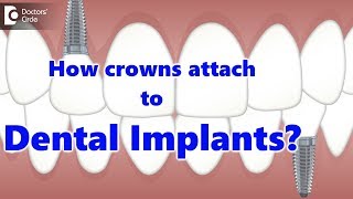 How crowns attach to Dental Implants  Dr Manesh Chandra Sharma [upl. by Neda]