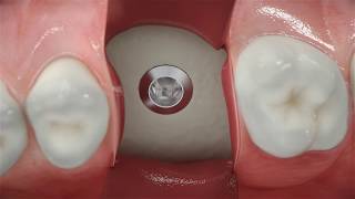 Straumann® BLX  Conventional posterior implant placement [upl. by Jacqueline]