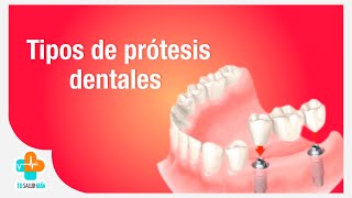 Tipos de prótesis dentales  Tu Salud Guía [upl. by Drislane]