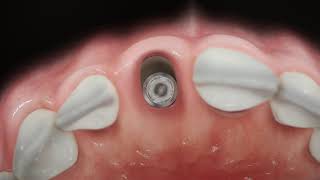 Straumann® BLX  Immediate anterior implant placement [upl. by Trebliw]