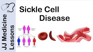 Sickle Cell Disease  Pathophysiology Symptoms and Treatment [upl. by Amsed254]