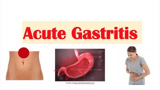 Acute Gastritis Stomach Inflammation  Causes Signs amp Symptoms Diagnosis Treatment [upl. by Streetman]