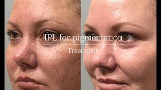 IPL for pigmentation  treatment video [upl. by Drews]