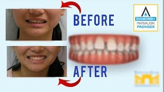 Invisalign Before and After Gap in Teeth [upl. by Paulita]