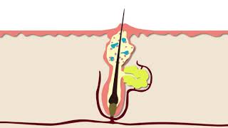 How Acne Develops  Acne Support [upl. by Dnomal]