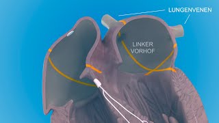 Herzrhythmusstörungen  das Vorhofflimmern [upl. by Hamlin]