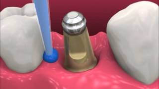 Smyl Manatee  Dental Implant Procedure [upl. by Mead614]