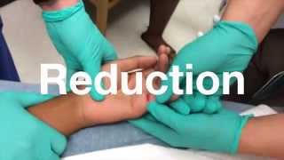 How do I Treat a Dislocated Thumb [upl. by Childs]