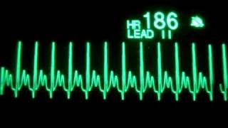 Atrial Tachycardia [upl. by Nale]