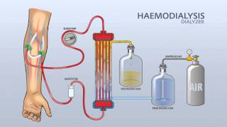 HAEMODIALYSIS DIALYZER [upl. by Sachi164]