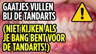 Gaatjes Vullen Bij De Tandarts  Filling Cavities At The Dentist ENG SUBS [upl. by Isolde926]