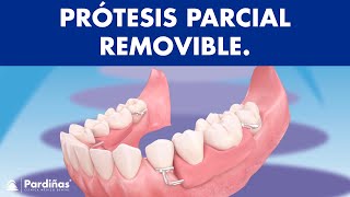 Prótesis parcial removible  ¿Cómo funcionan © [upl. by Enirahtak323]