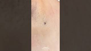 shorts Big Underarm Blackhead Removal DPOW Extraction  CONTOUR DERMATOLOGY [upl. by Tremann376]