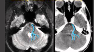 Developmental Venous Anomaly quotVenous Angiomaquot  a Vascular Malformation [upl. by Akaenahs]