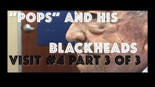 quotPopsquot and his blackhead extractions Visit 5 including skin biopsy [upl. by Lleder]