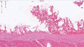 Fibrinous Pericarditis  Histopathology [upl. by Adnylg]