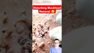 Disturbing BLACKHEADS REMOVAL shorts [upl. by Ailemrac]