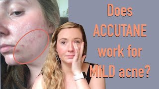 My Accutane Experience MILD persistent acne [upl. by Attenehs]