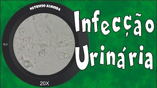 Infecção urinária  Piúria bactérias e muco [upl. by Yhtuv25]