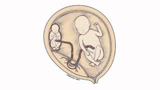 TwintoTwin Transfusion Syndrome and Fetoscopic Laser Surgery [upl. by Ahsilaf]