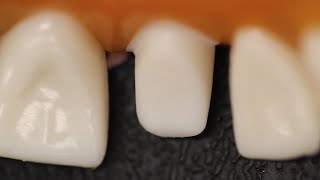 All Ceramic Crown Anterior Tooth Preparation [upl. by Rooker]